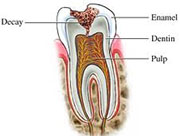 What are the forms and types of caries