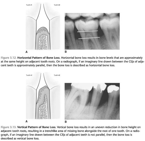 Patterns Of Bone Loss In Periodontitis Foundations Of Periodontics Smoking And Patterns Of 7979